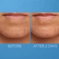 Kate Somerville Eradikate Acne Treatment 1 fl oz