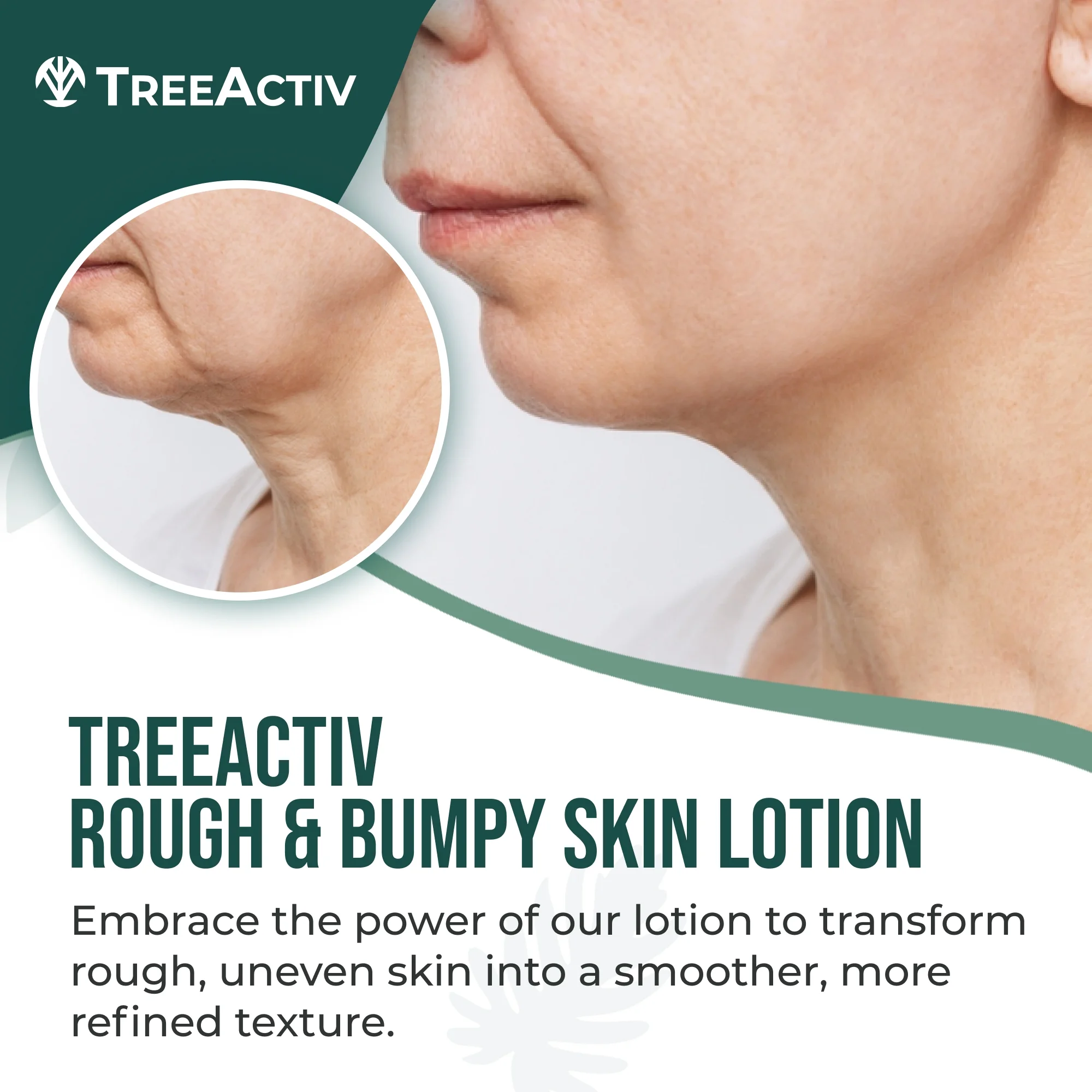 TreeActiv Rough and Bumpy Skin Lotion 8 fl oz, Hyaluronic Acid, Shea Butter & Vitamin E