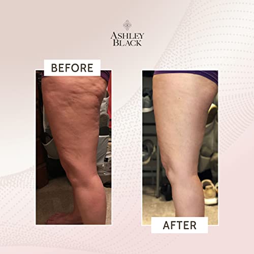 FasciaBlaster The ProBlaster Handheld by Ashley Black. Scientifcally Proven MyoFascial Tools. Gentle Massage with Effective Results. Releive Full Body Tension and Anti-Cellulite